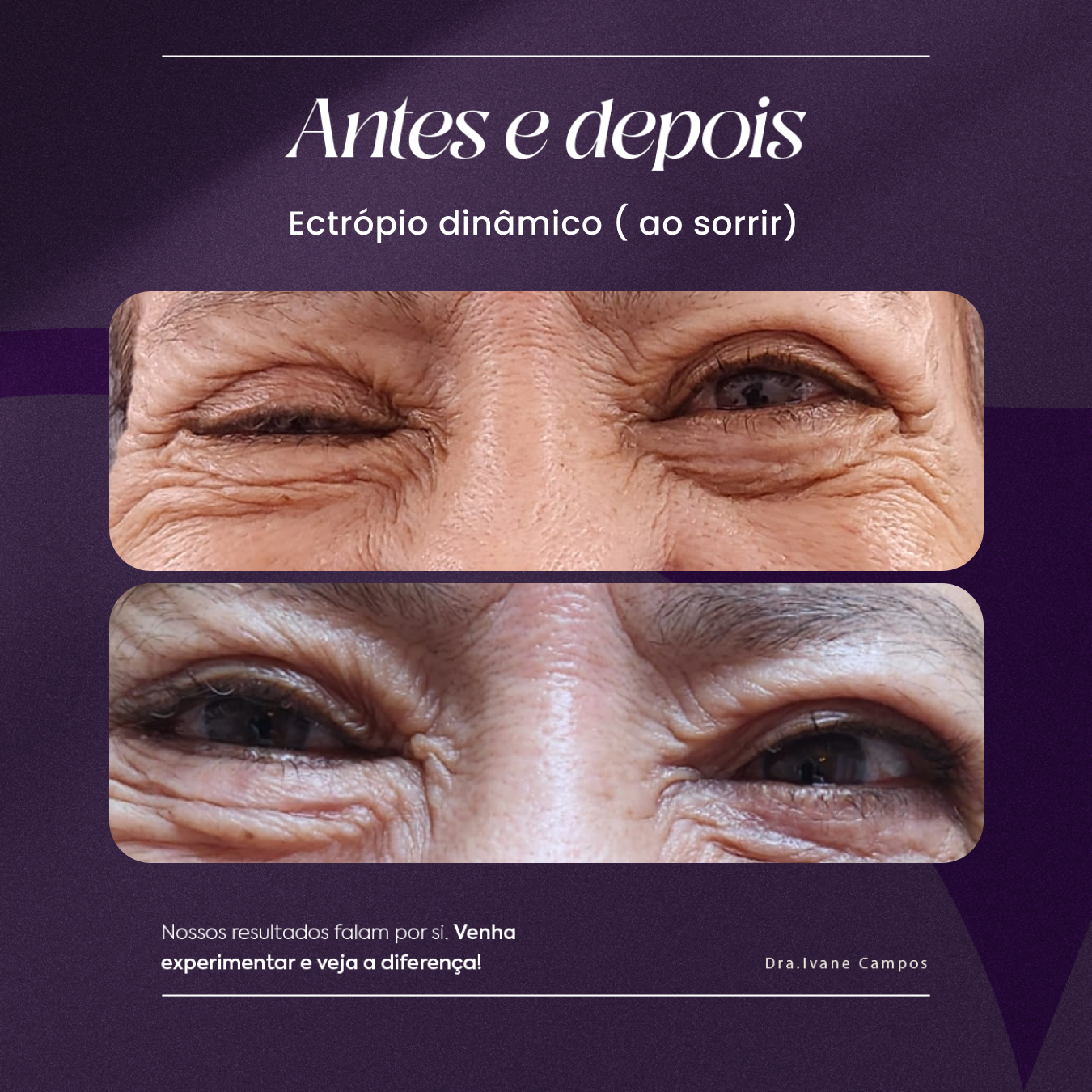 Ectrópio dinâmico ( ao sorrir)