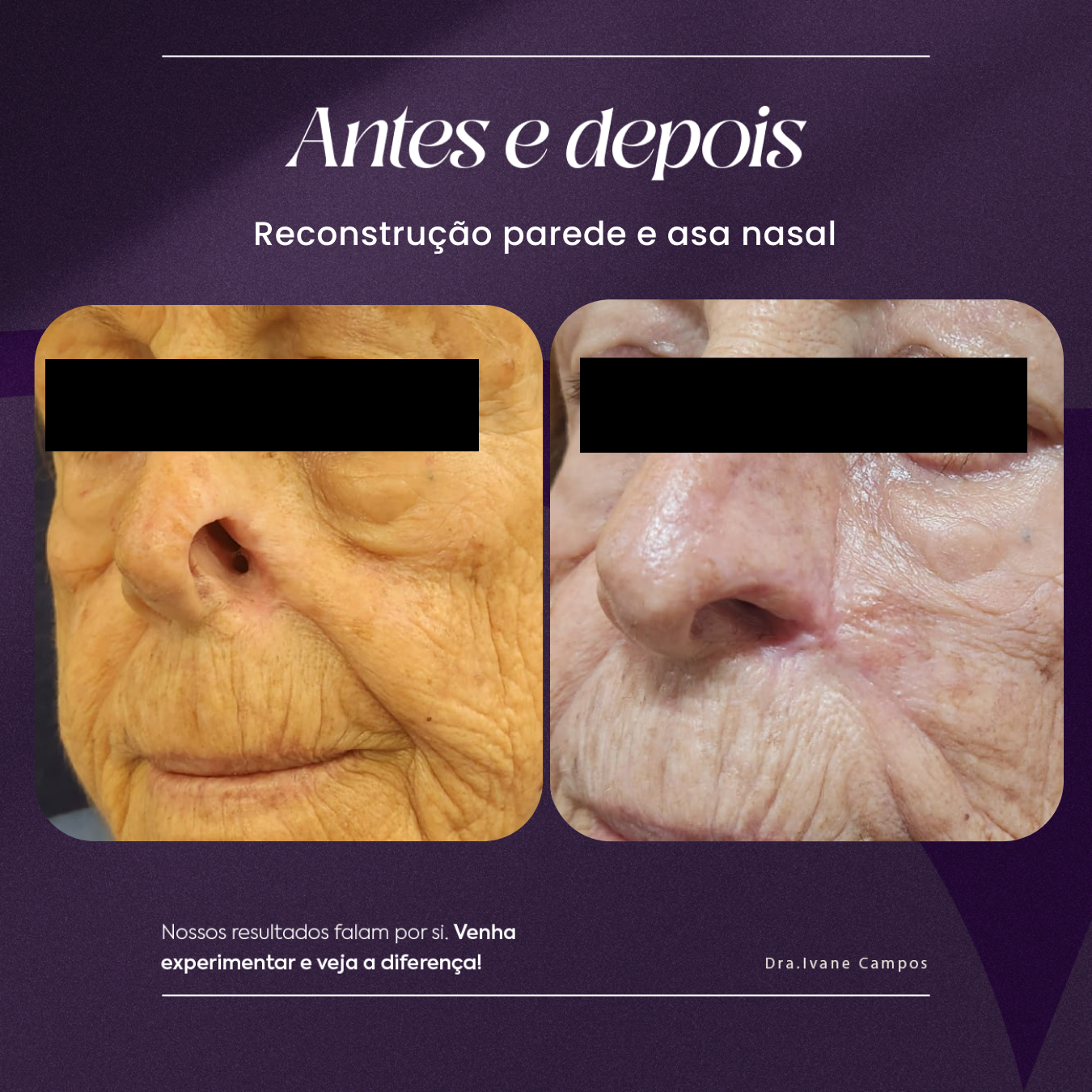 Reconstrução parede e asa nasal