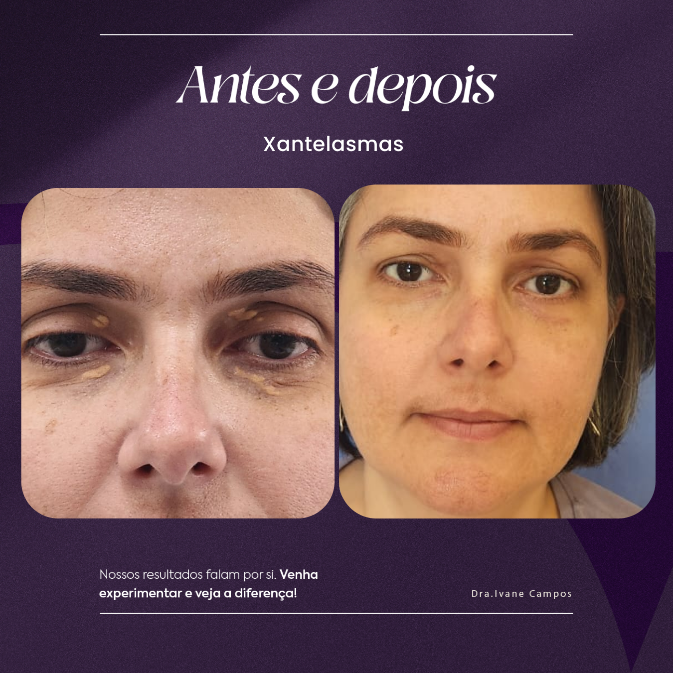 Xantelasmas